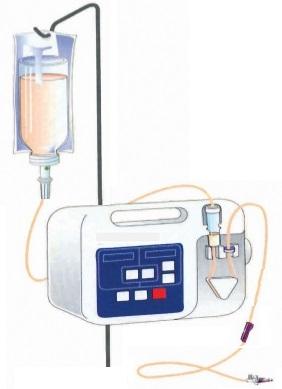 Nutrición enteral